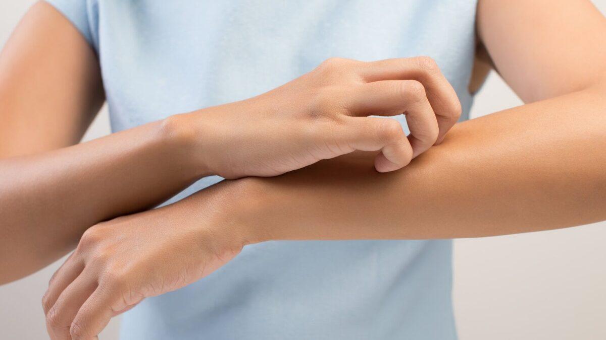 Conozca los síntomas y los signos de alarma de la dermatitis atópica