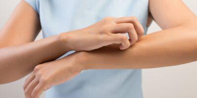 Conozca los síntomas y los signos de alarma de la dermatitis atópica
